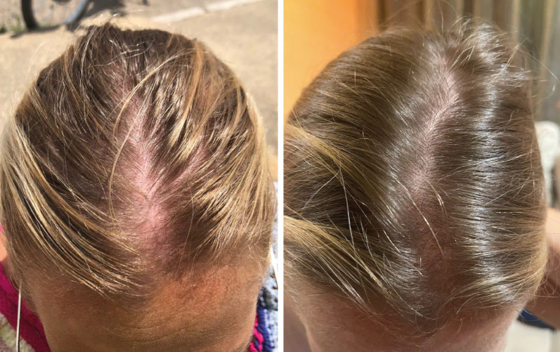 Shampoo Excalvo 🌸- Fortalecimiento Capilar 💆‍♀️